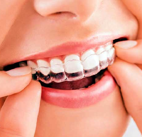 Clear Aligners