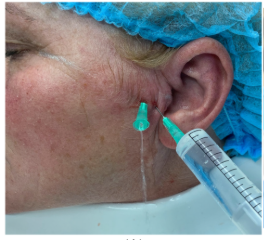 Arthrocentesis Procedure