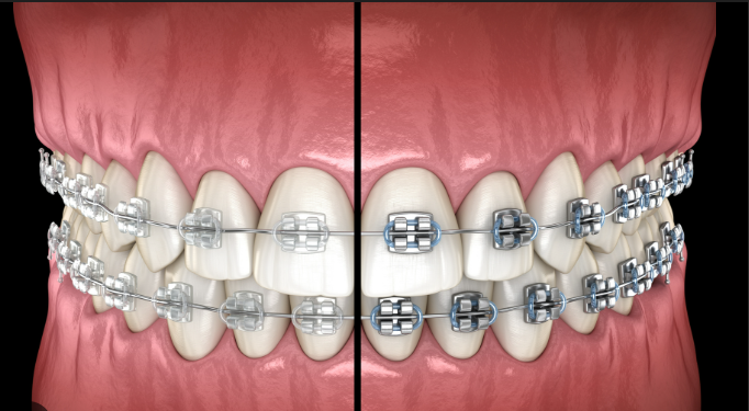 Types of Braces