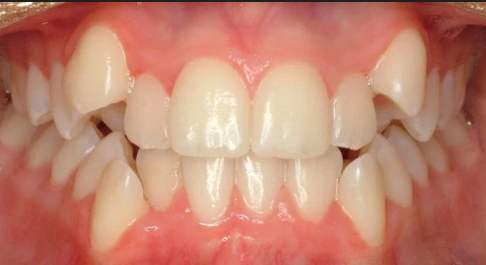 Crowded Teeth