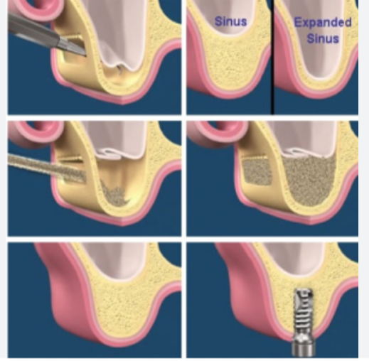 Direct Sinus Lift