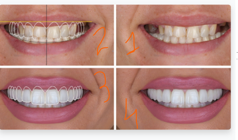 Digital Smile Design Process