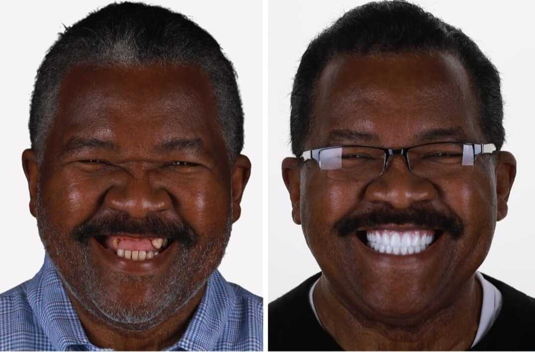 Dental Implants