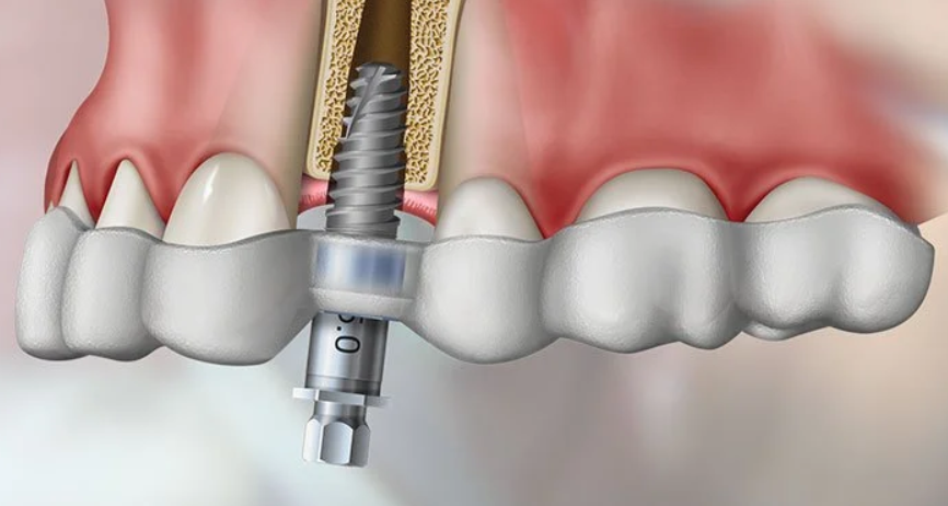 Guided Implant Placement