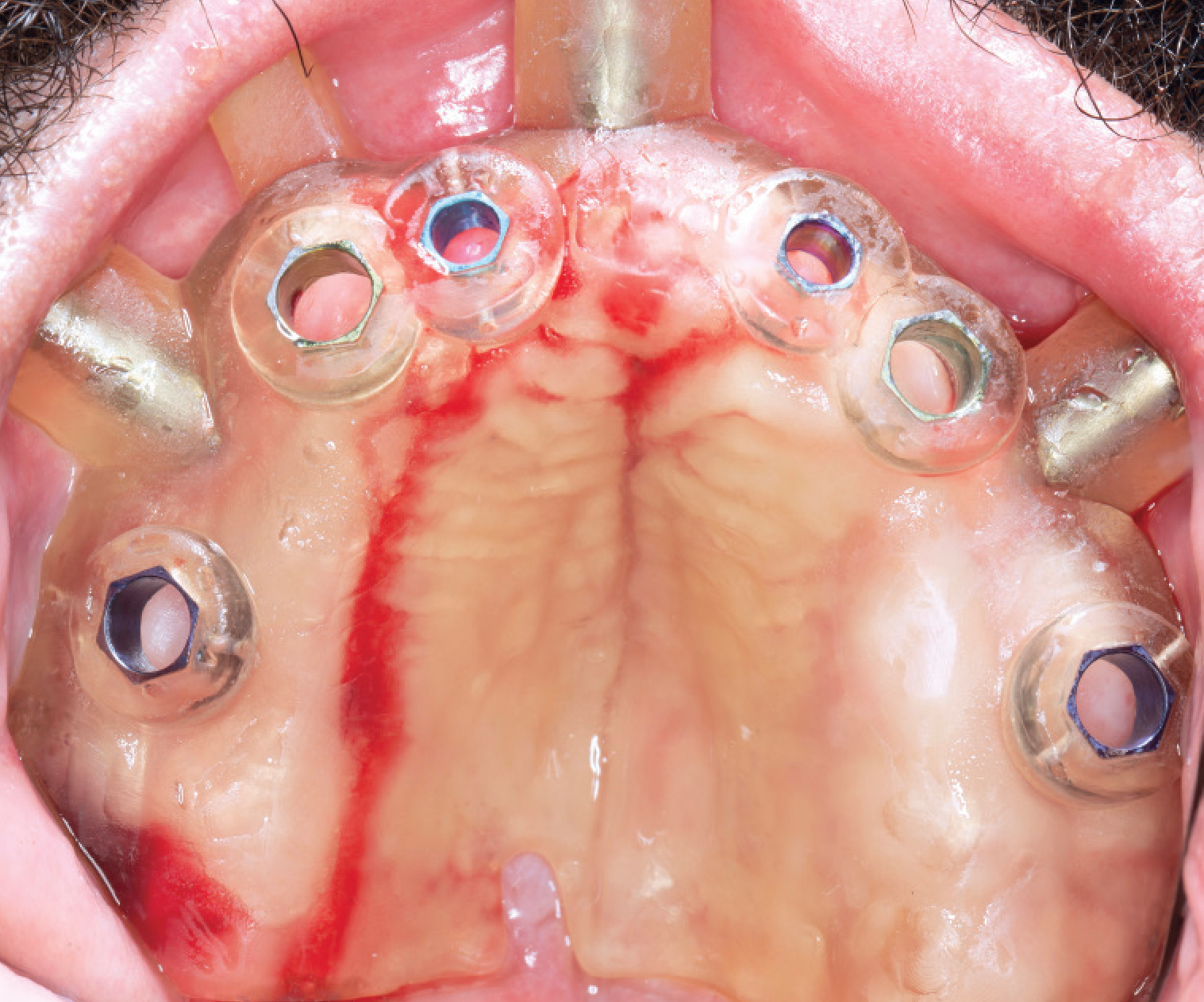 Guided Implant Placement 1