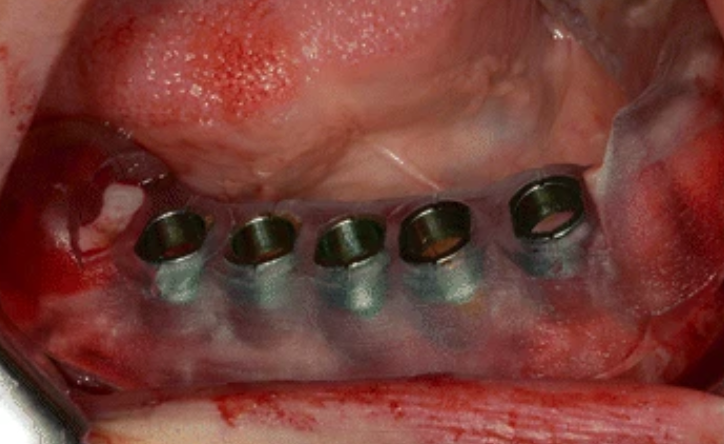 Guided Implant Placement 2