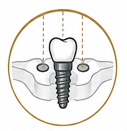 Guided Implantology