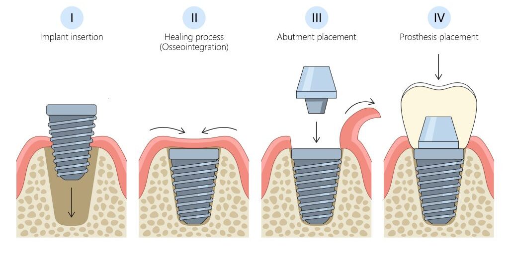 Implant Procedure