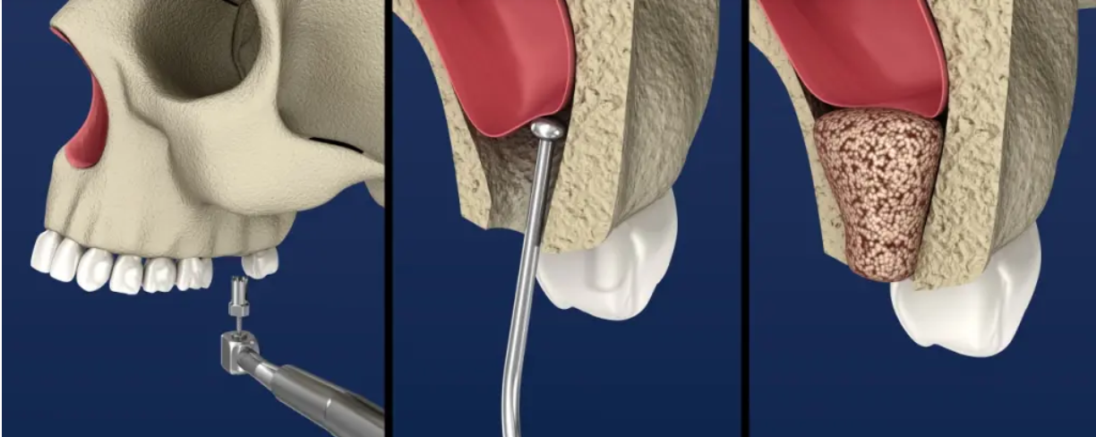 Indirect Sinus Lift