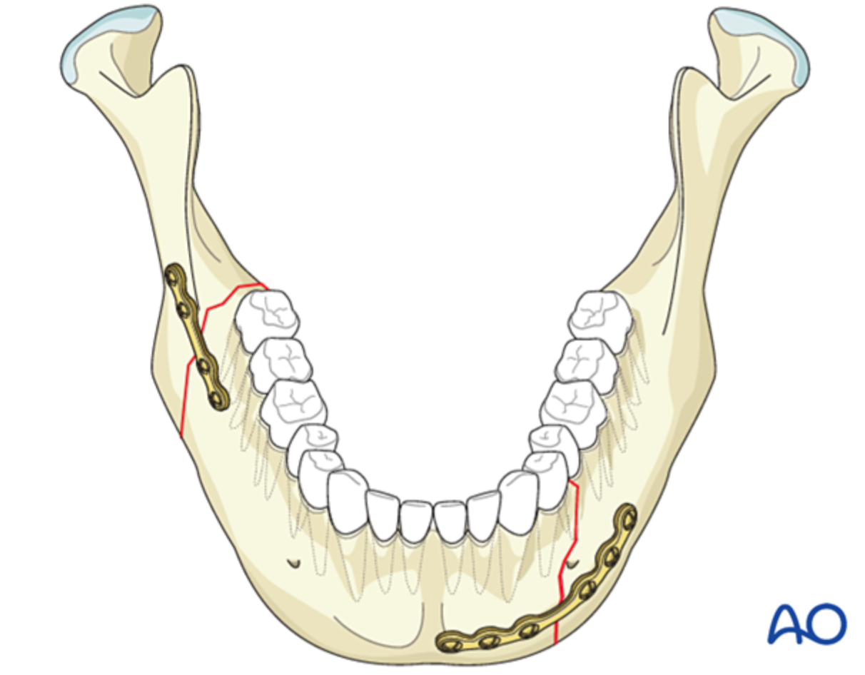 Surgical Reconstruction