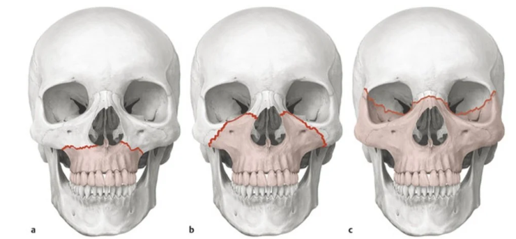 Jaw Fracture Treatment