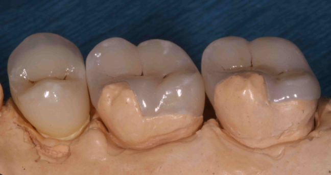 Minimally Invasive Dentistry Approach