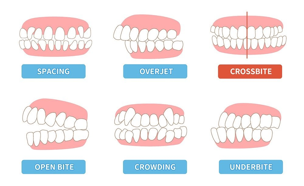 Types of Misaligned and Crooked Teeth