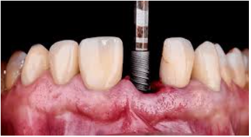 Non-Guided Implant Placement