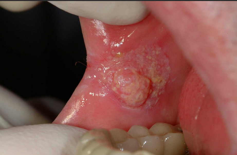 Oral Cancer Treatment