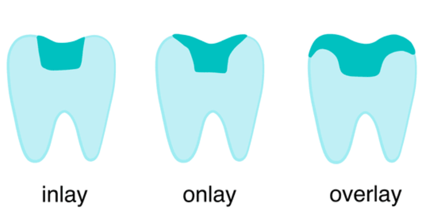 Partial Bonded Restoration