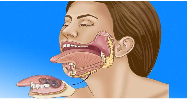 Oral Cancer Surgery Process