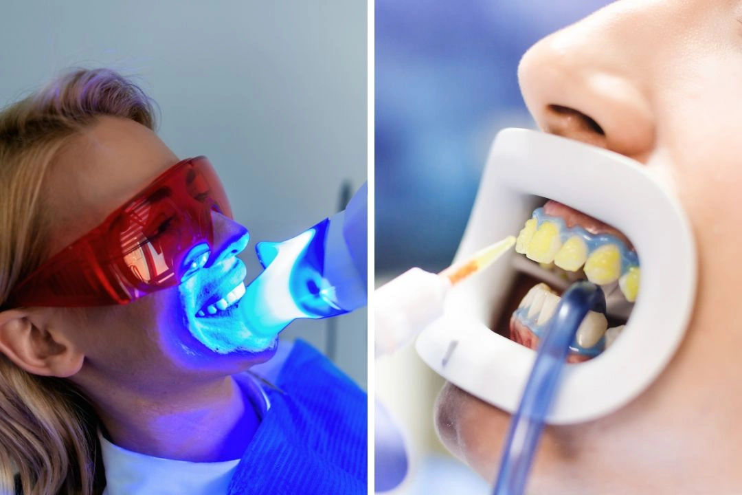 Teeth Whitening