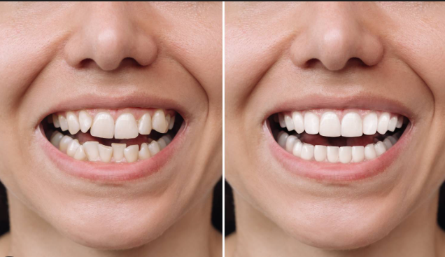 Why Correct Crowded Teeth